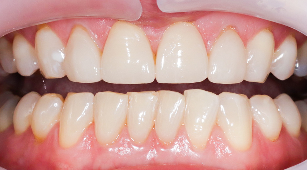 veneers-muenchen-zahnbehandlung-keramikveneers-behandlungsergebnis-zahnlaengenkorrektur-vorher